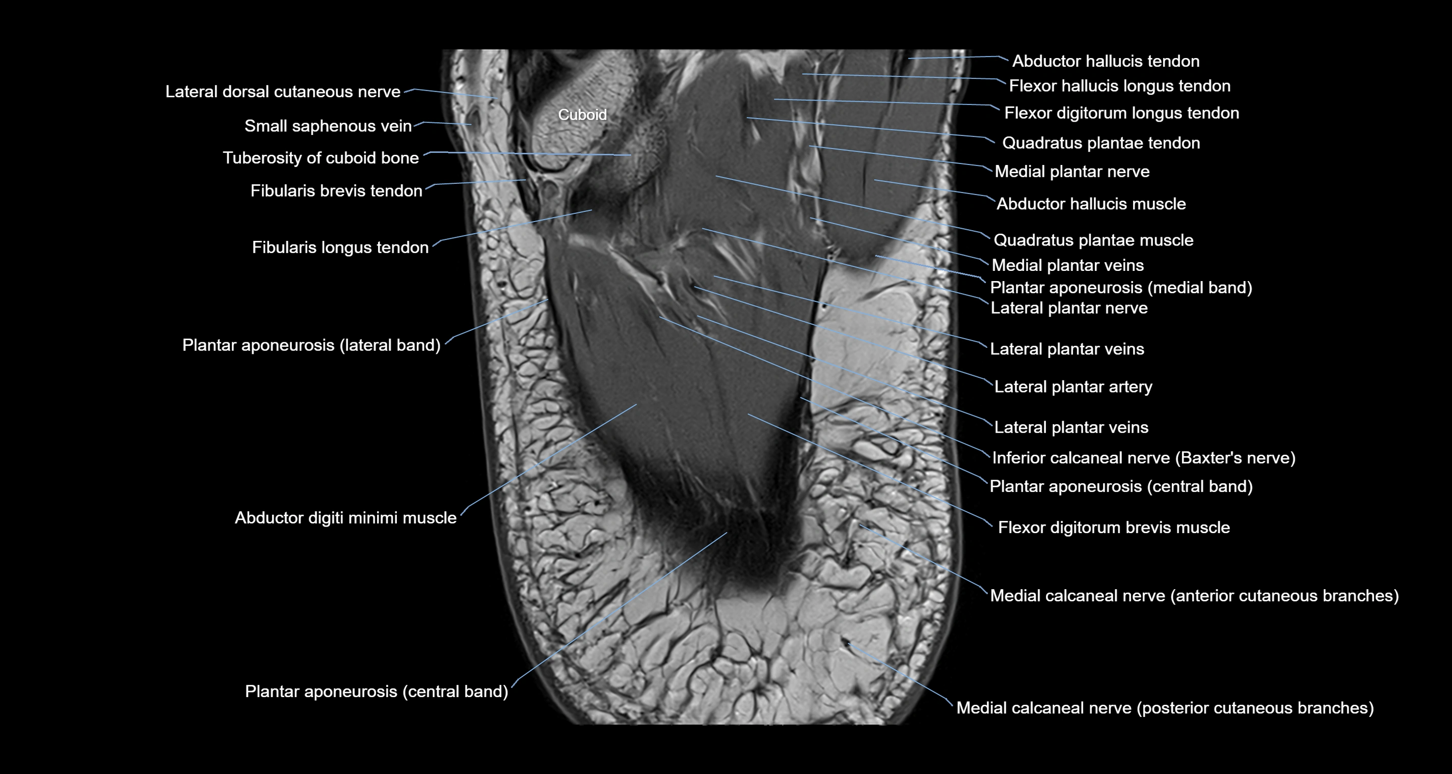 Ankle axial anatomy 3T MRI images -img-10001-00038.webp